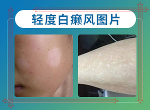 白颠风病因-脸上出现一小块一小块白的怎么回事