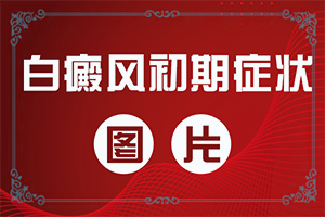适用于局部治疗没有，白斑分布广的患者。（采取哪些措施）