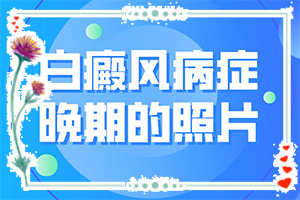 [常用方法有哪些]儿童白颠疯病可以治疗好吗