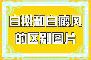 [哪些禁忌是不能违反]白颠疯病可以治疗好吗