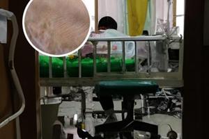 局限型白癜风用308准分子激光一般做几次就好了