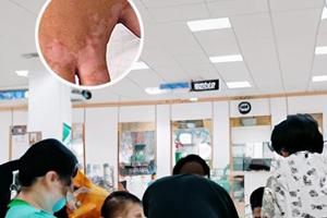 涂了复方卡力孜然酊白斑明显