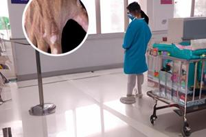 他克莫司软膏主治什么病症