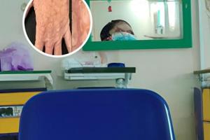 贵州白癜风皮肤病医院能消除颈部白斑吗