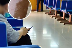 伍德灯检查结果要多久