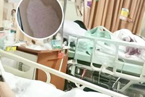 他克莫司瘙痒持续多久