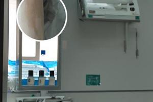 308激光治疗一次多长时间最好