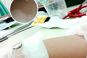 复方甘草酸苷片治疗白点效果好吗