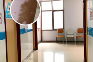 伍德灯费用多少钱