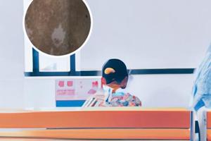 贵州白斑皮肤病医院怎样治疗白斑的