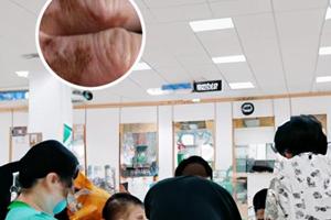 涂了卤米松软膏后皮肤变皱