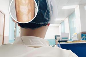 贵州白癜风皮肤病医院有308激光吗