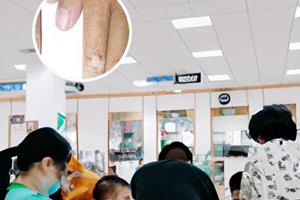 涂了复方卡力孜然酊之后起水泡