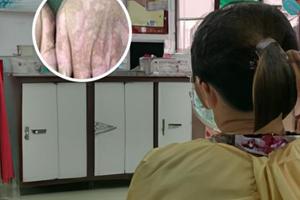 他克莫司软膏治疗白斑01和03