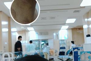 中胚层疗法和308治白斑哪个好些