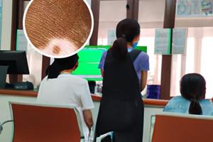recell手术后皮肤是什么样