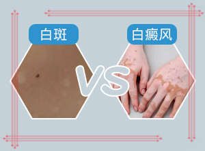 白癫疯的症状是什么,会有什么表现(身体上有一小部分)