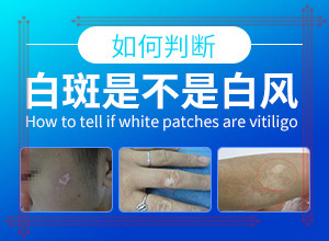 小宝宝身上有白色斑-不同时期是什么症状